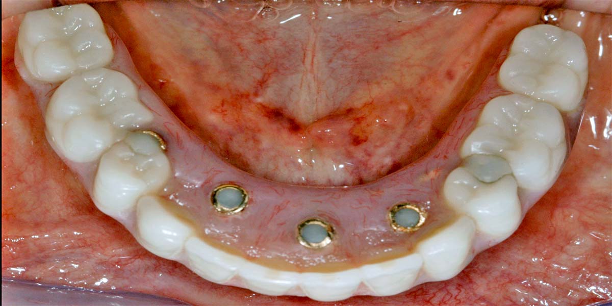 Azonnal Terhelhető Implantátumon Rögzített Fogsor Gondozás