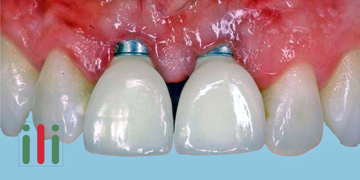 Lehetséges problémák az implantátumokkal