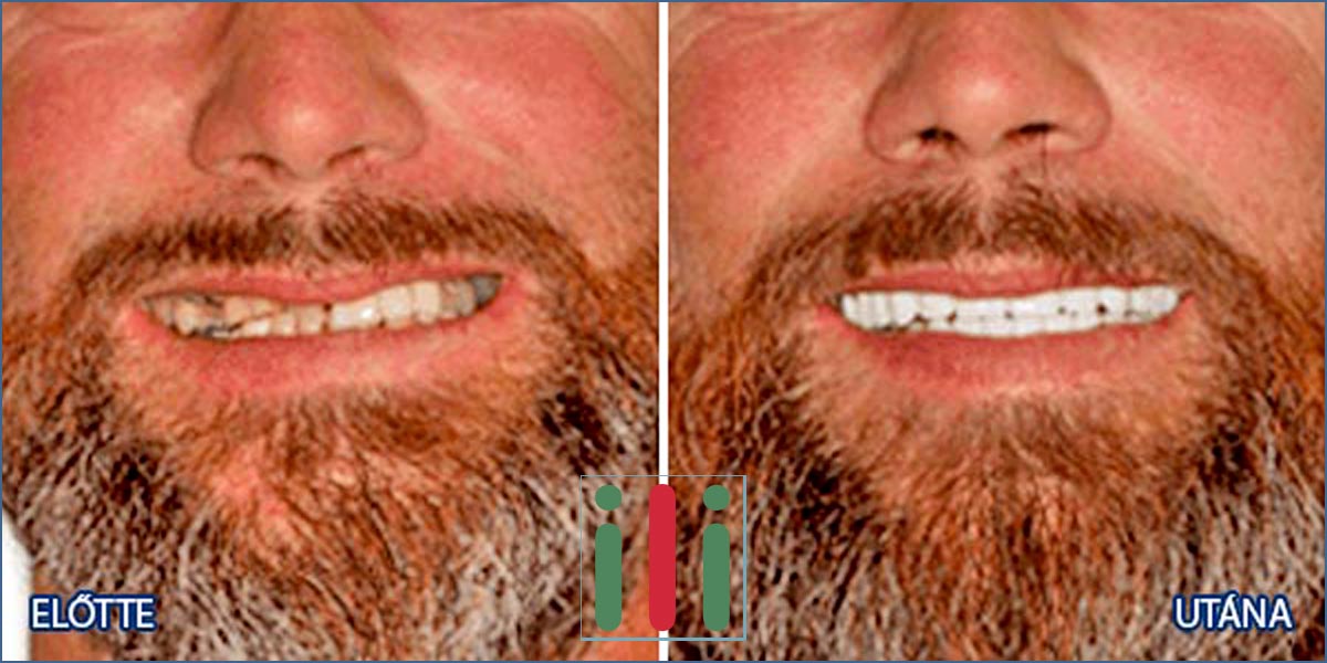 Egyfázisú Implantátum - Miért Érdemesebb Ezt Választani?Miért jó választás az azonnal terhelhető egyfázisú, implantátum teles fogsorhoz?