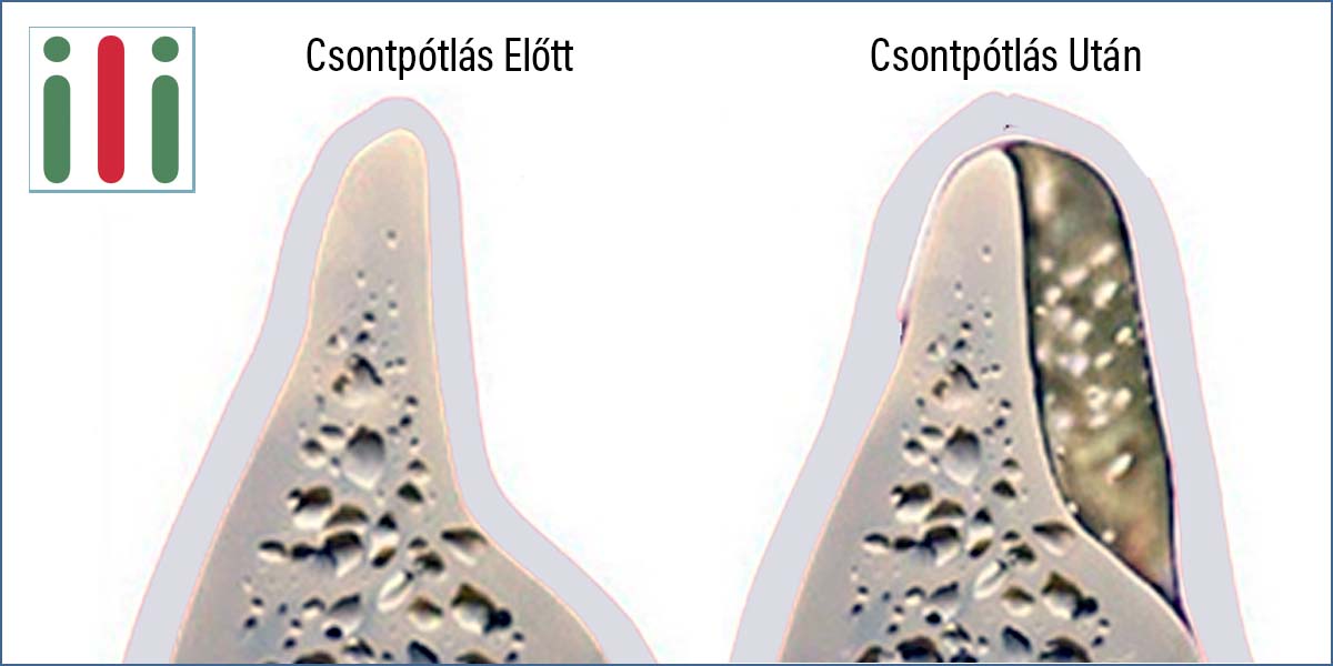 Fogászati Csontpótlás - Vajon Szükséges Implantátum Beültetés Előtt?