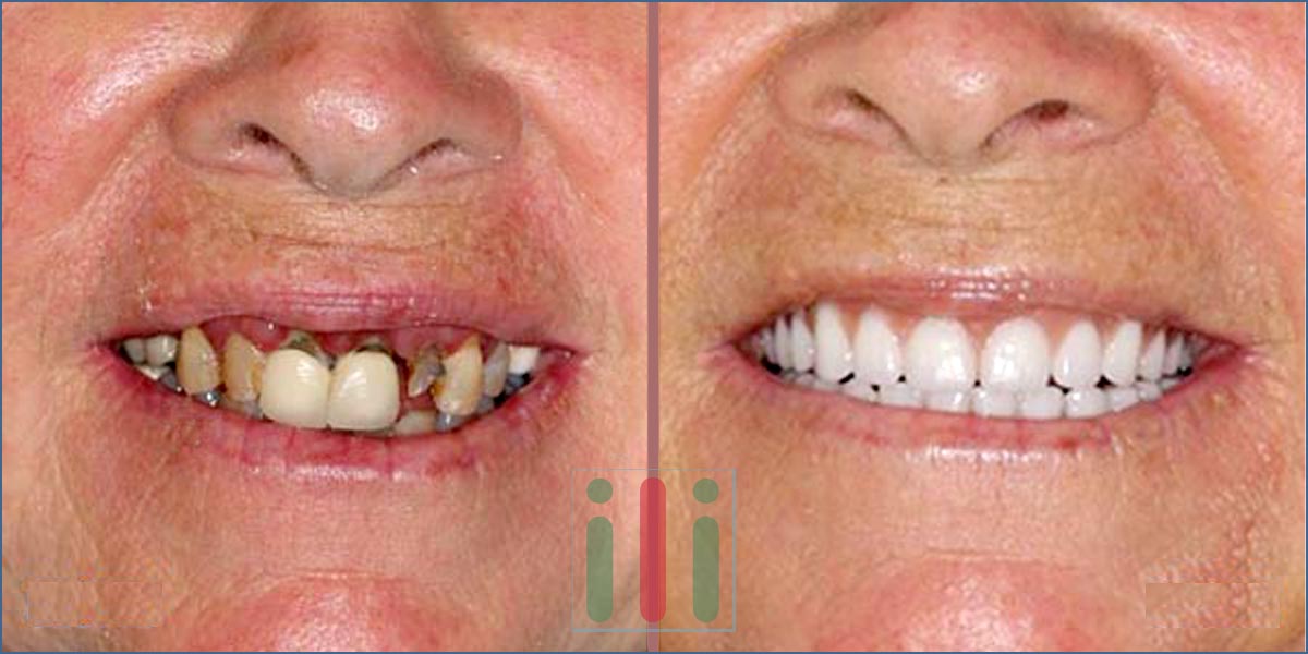 Full Bridges in 5 Days with One-Phase Implantation Process