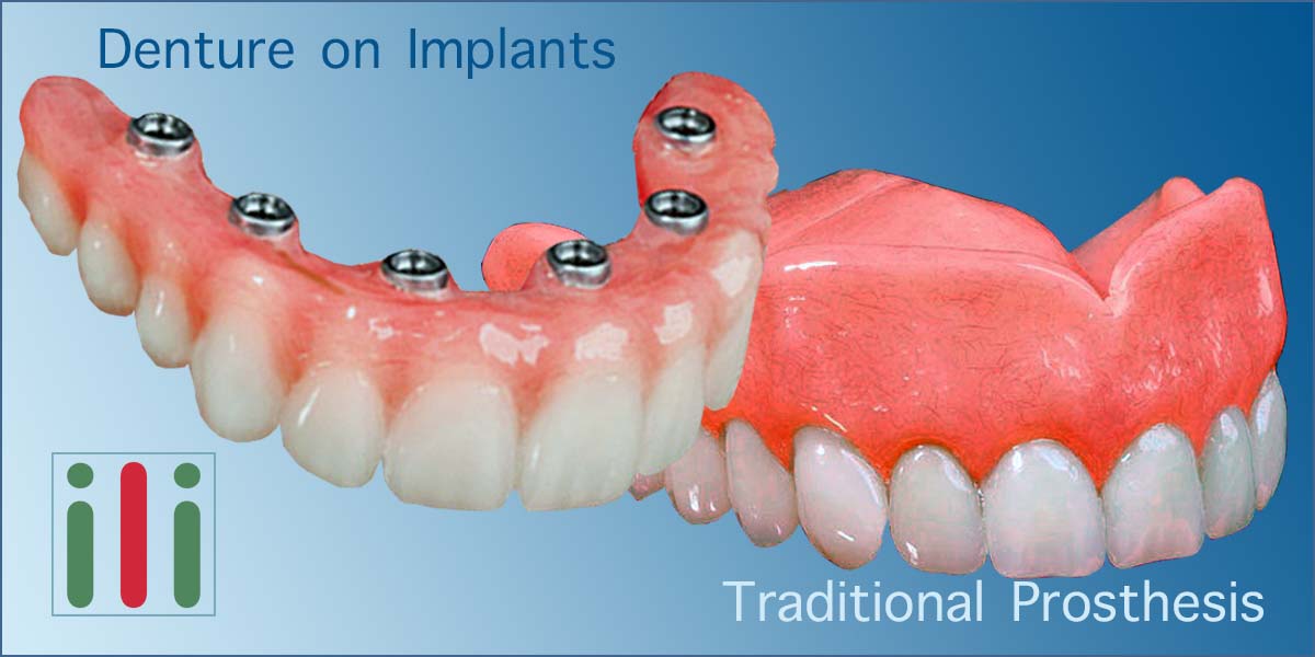 Benefits of Implants - Why Immediate Loading Implants beneficial for you?