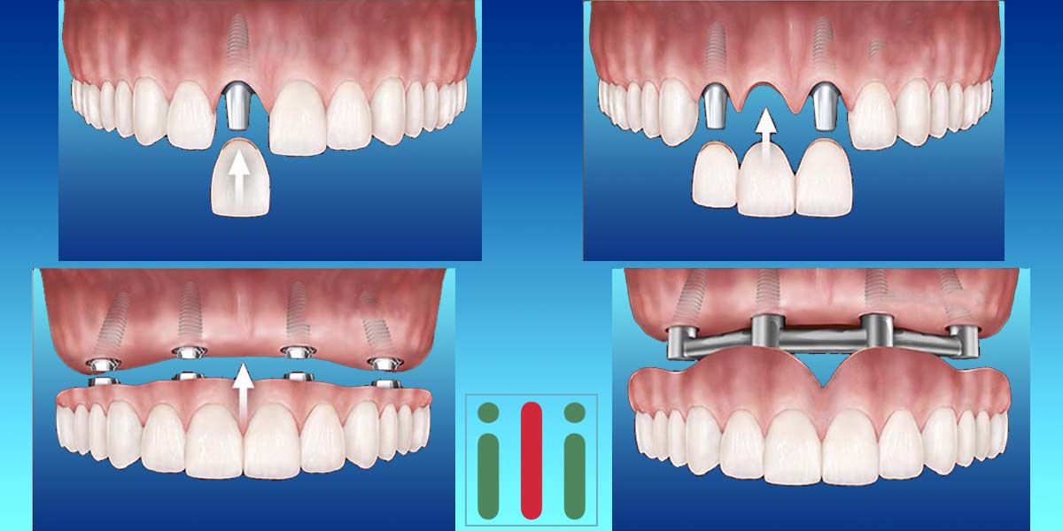 Korona Híd Körhíd Fogpótlás Implantátummal a Tökéletes Megoldás