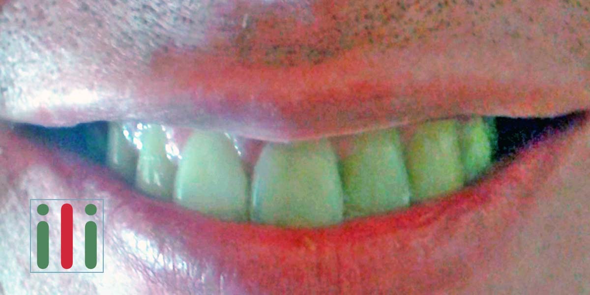 A Fogbeültetés Egyfázisú Implantátummal Határozott Előnyei