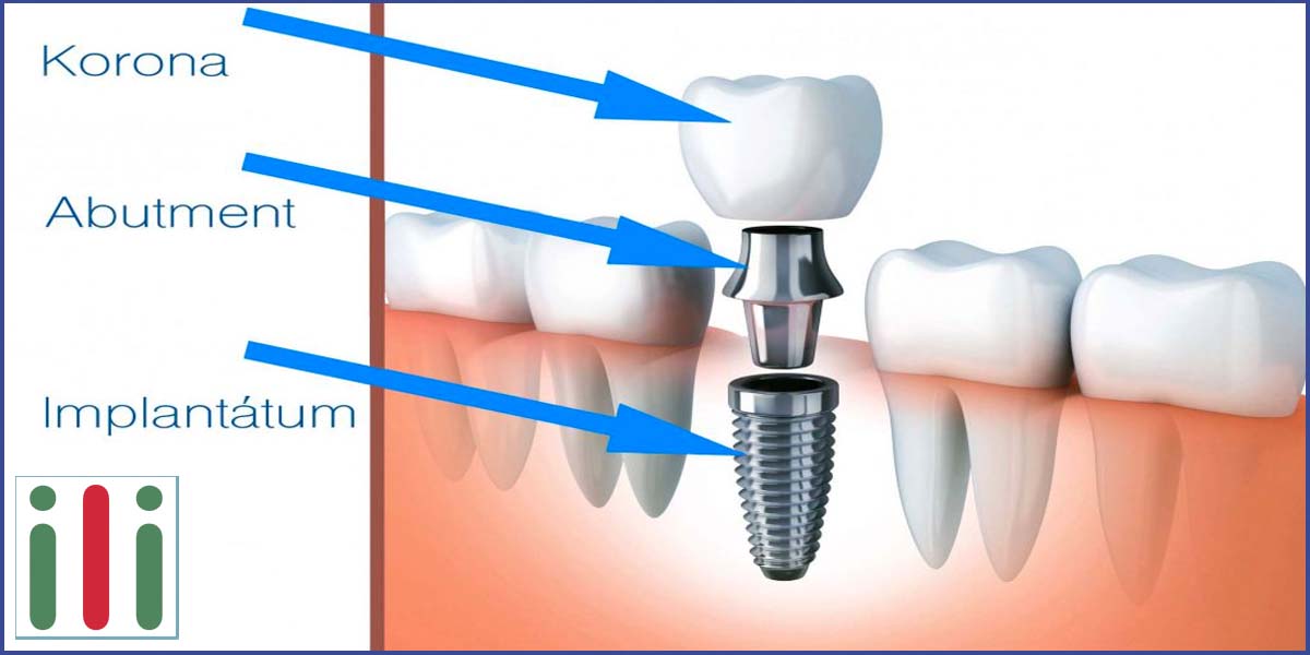 Kétfázisú implantátum - Hagyományos Módszer