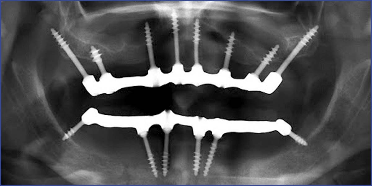 Az egyfázisú implantátum előnyei - Fogpótlás implantátummal