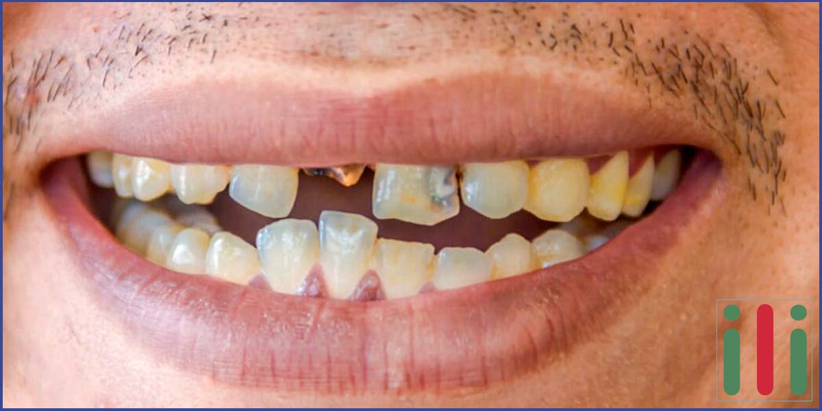 Elhanyagolt Fogak Okozta Betegségek