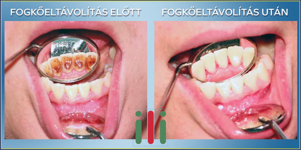 Fogkőeltávolítás és az Egészséges Fogazat Közötti Összefüggés