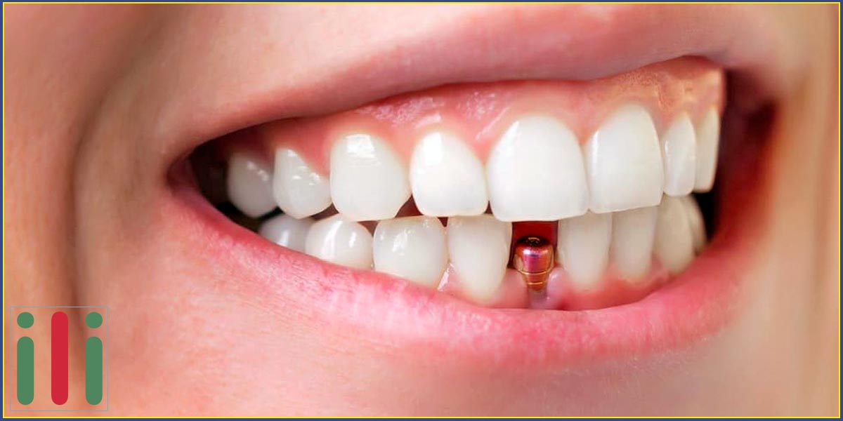 Implantátum Beültetés, Fogbeültetés - Mi a Különbség?