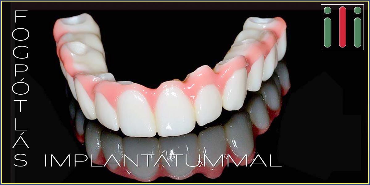 Fogimplantátum Fogbeültetés Fogpótlás Implantátummal