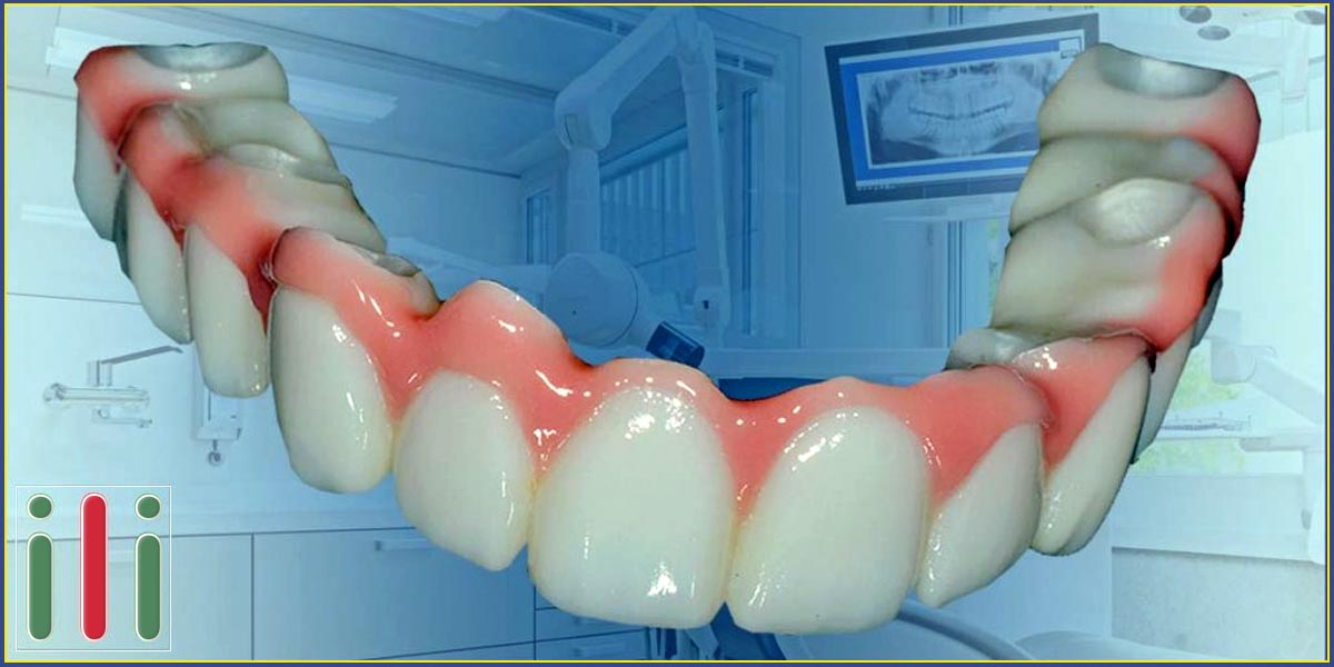 Fájdalommentes fogbeültetés, a tökéletes fogpótlás