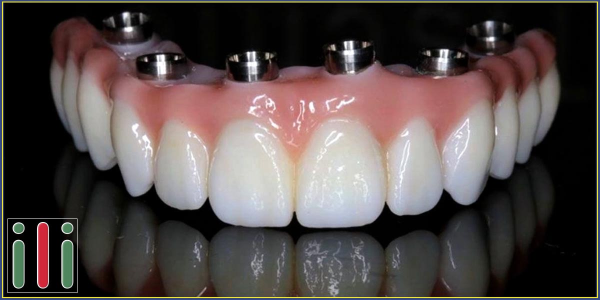 Fog implantátum beültetés alapú fogsor, ami egy életre szól