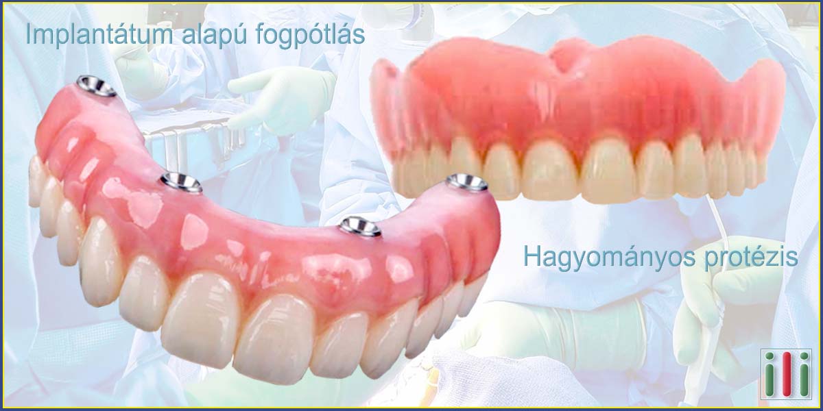 Fogbeültetés vagy hagyományos fogpótlás, melyiket válasszam
