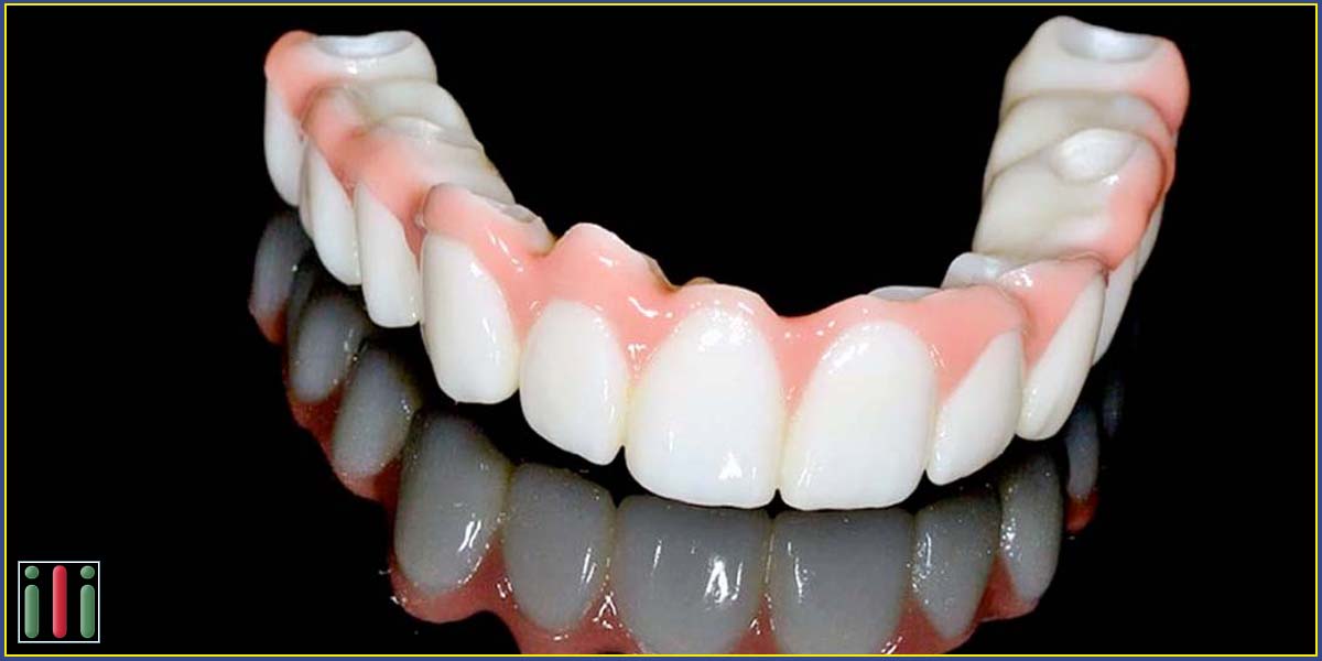: Bridges with immediate loading implants - The best solution for life