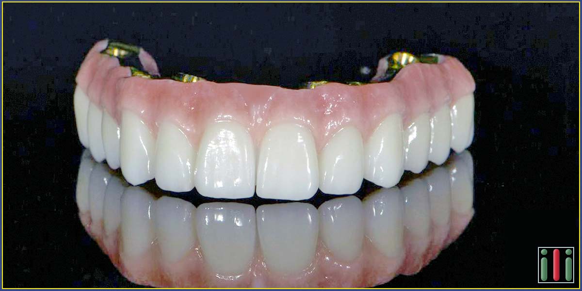 Complete denture on implants - How the process goes