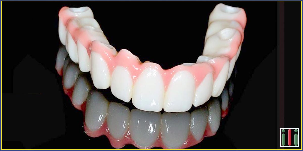 One-phase implant-based denture by implantation specialist in Budapest
