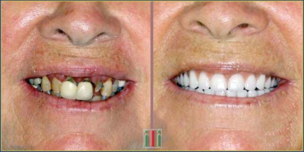 One-phase implant based oral rehabilitation in Budapest, Hungary
