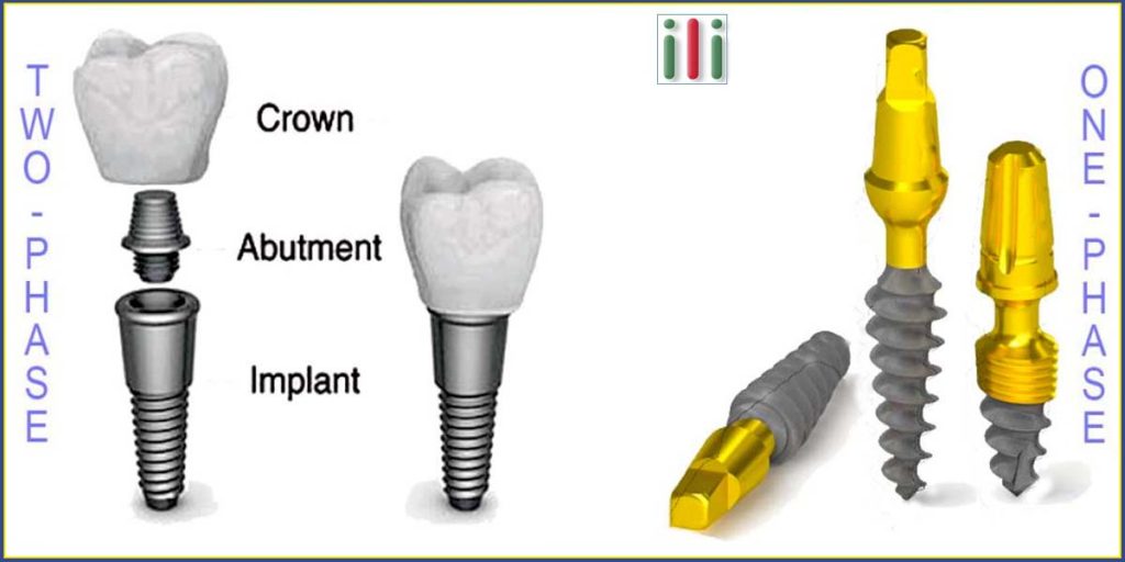 One-phase-implant vs. two-phase implant - What are the differences