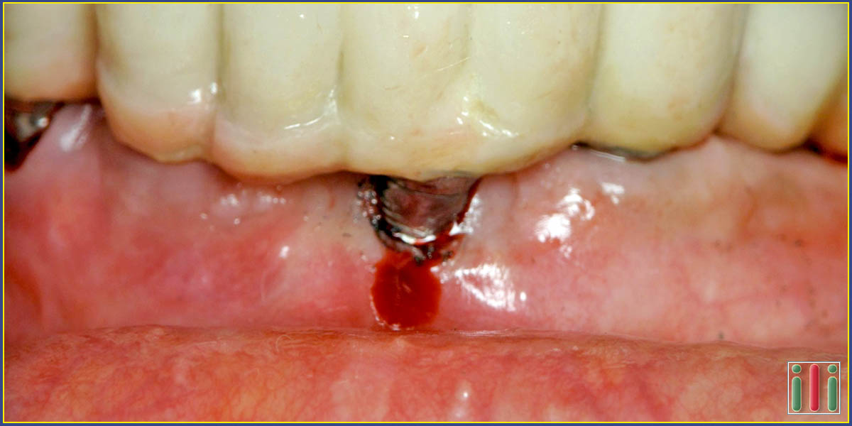 Problems with dental implants - What can go wrong