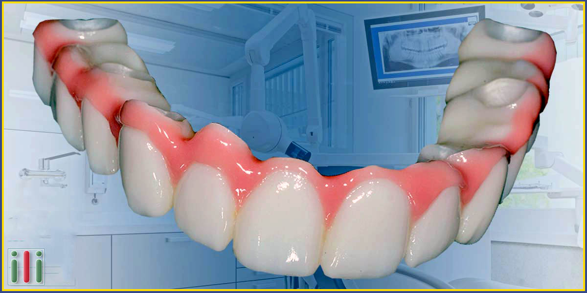Immediate loading Implant-based dentures