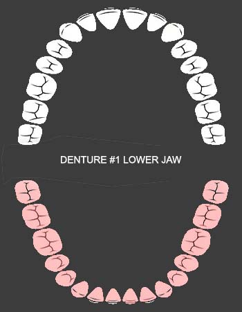 Dental Implantation Package Lower Jaw