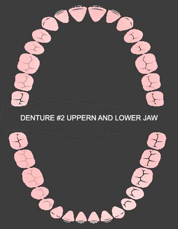 Dental Implantation Package Upper and Lower Jaw