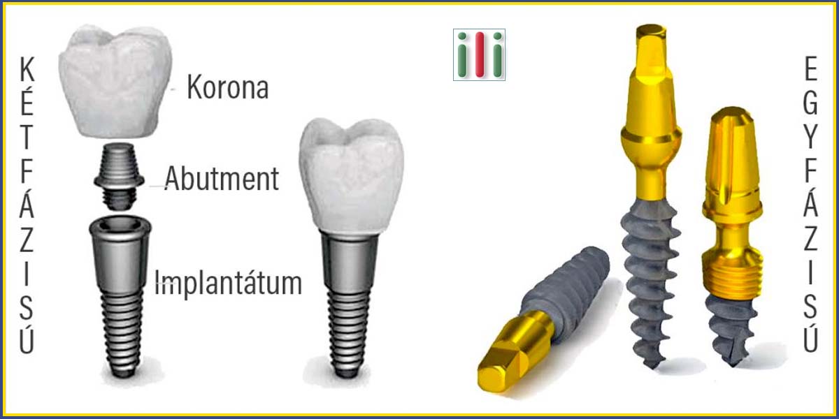 Egyfázisú fogászati implantátum vs. kétfázisú fogimplantátum
