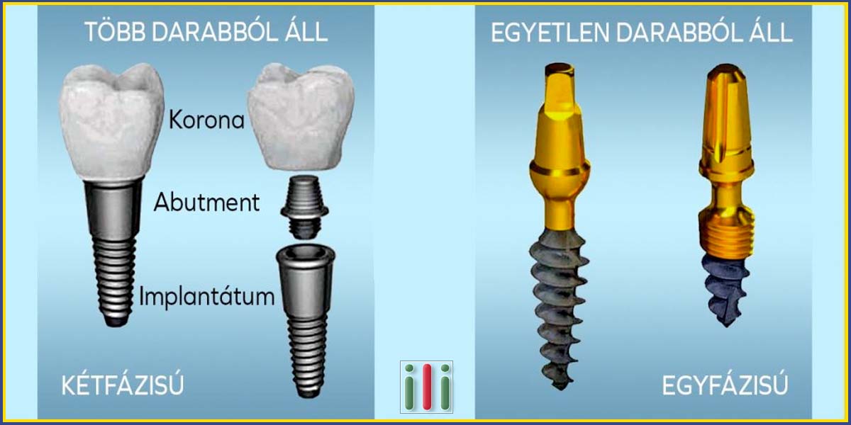 Fogpótlás fogászati implantátummal - Egy és kétfázisú implantátum