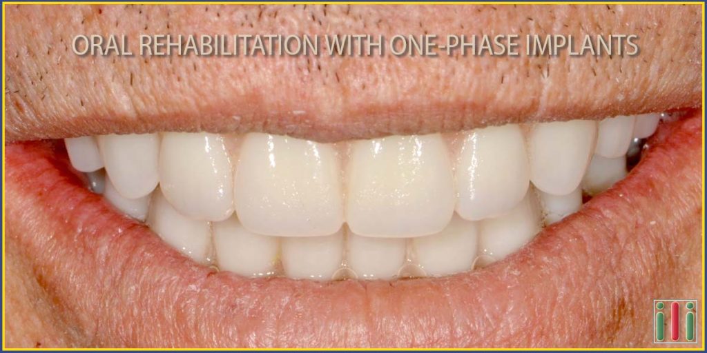 Oral rehabilitation with one-phase implant - How is it done?