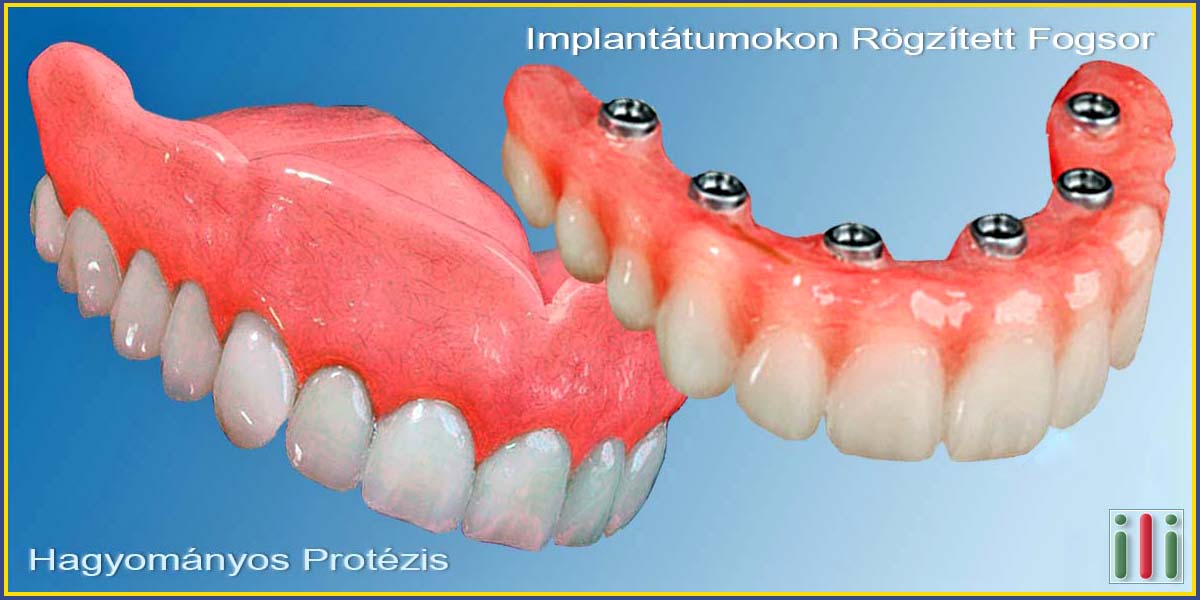 Fog implantátum beültetés vs. Hagyományos fogpótlás