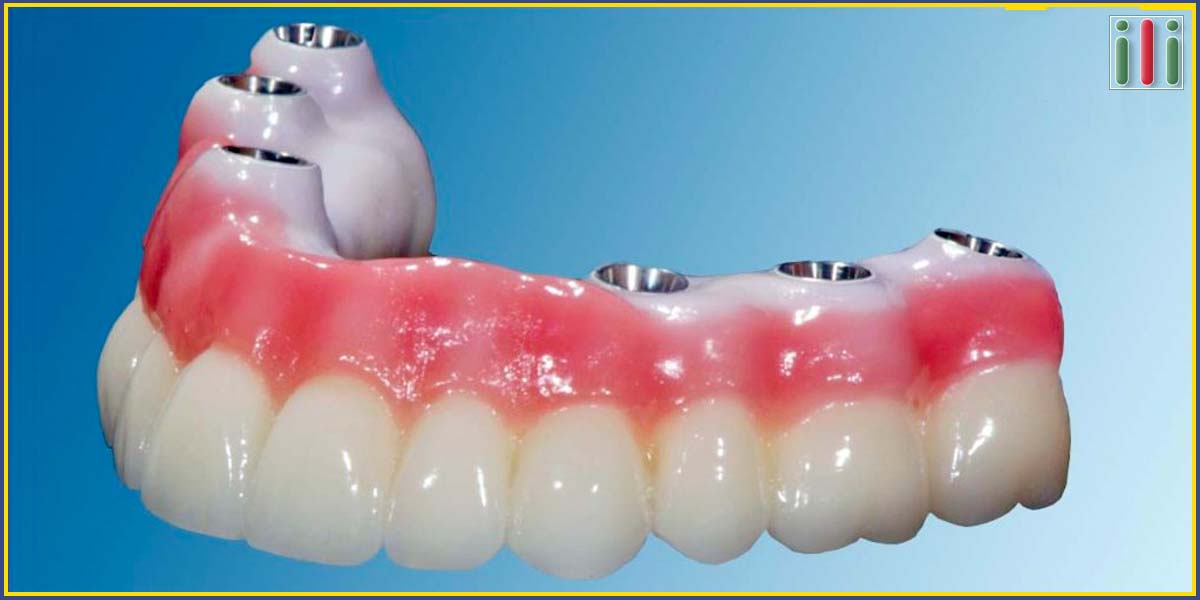 Teljes körhíd egyfázisú implantátummal altatásban