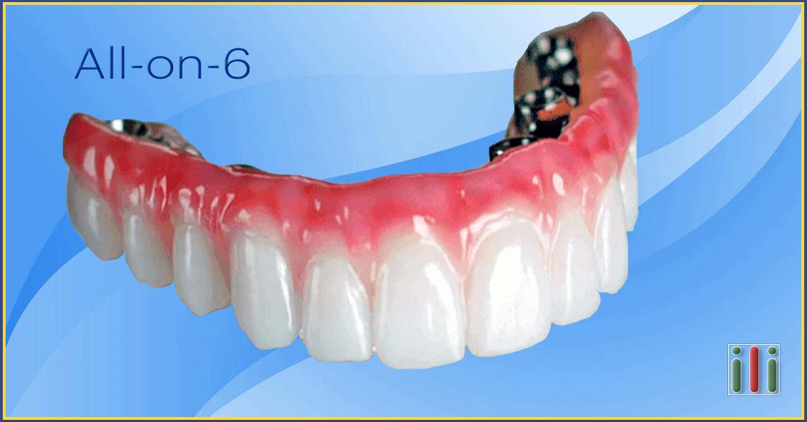 Az All-on-6 fogpótlás implantátummal gyors és gazdaságos száj rehabilitáció