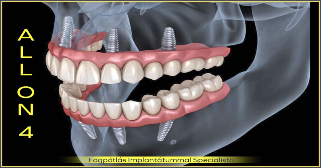 A fogpótlás implantátummal halogatás leggyakoribb okai, a halasztgatás lehetséges következményei