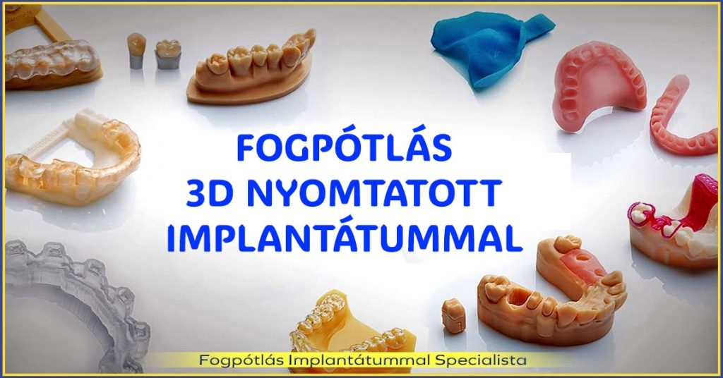 Fogpótlás 3D nyomtatott, biokompatibilis implantátummal