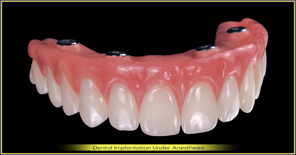 All-on-4 full dentures, pros and cons - who is it for?