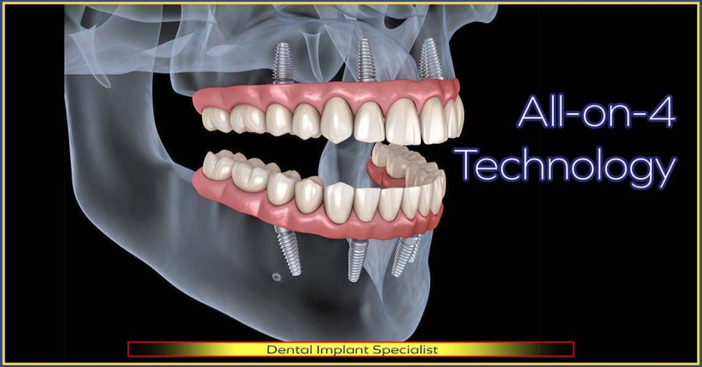 Dental implants under anesthesia, painless and stress-free