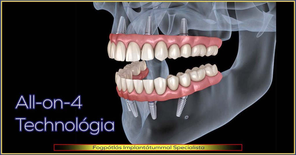 All-on-4 Technológia