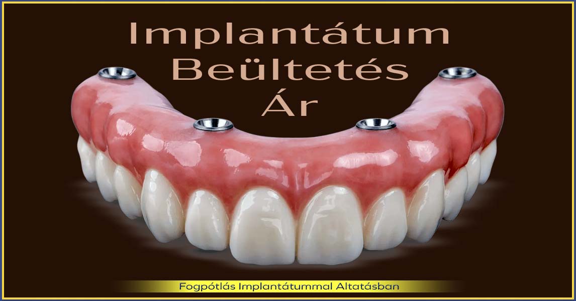 Implantátum beültetés ár – Megéri a befektetés a minőségbe és a biztonságba