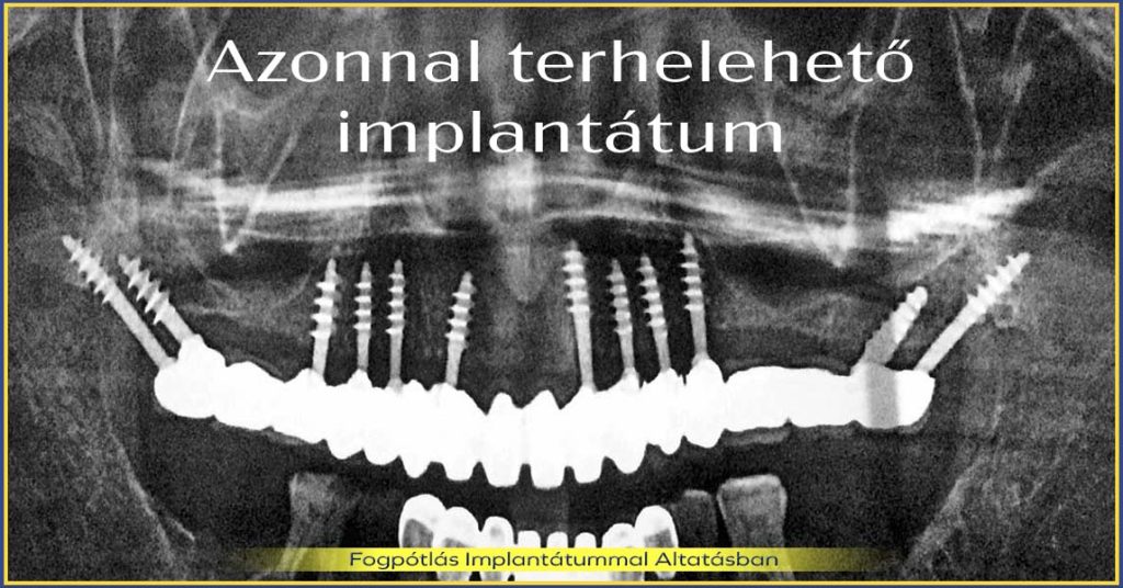 Azonnal terhelhető implantátum – új, stabil fogsor egy hét alatt