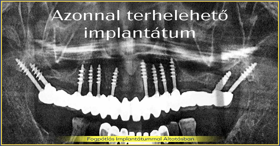 Azonnal terhelhető implantátum új, stabil fogsor egy hét alatt