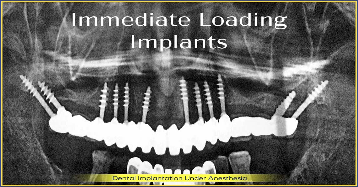 Dental implant placement under anesthesia full mouth rehabilitation