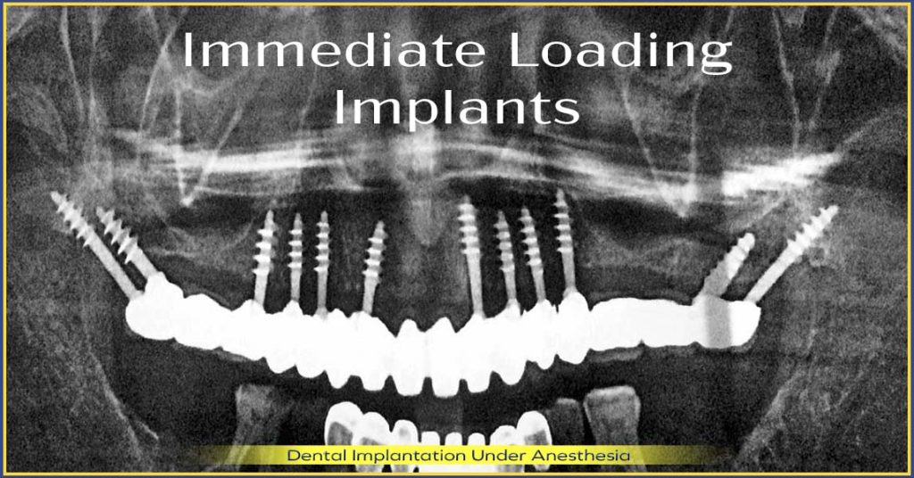 immediate loading dental implants – a new denture in just one week