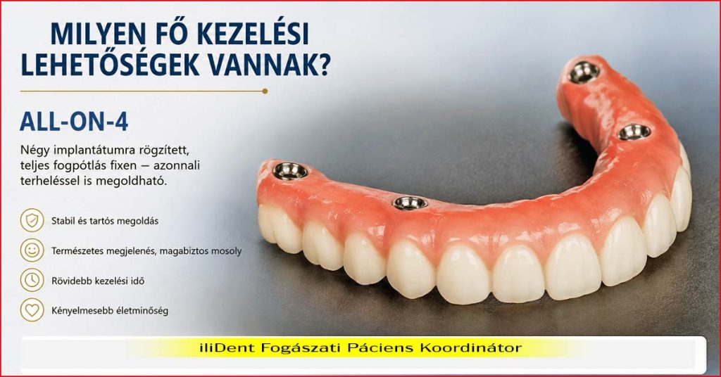 All-on-4 implantátum-alapú fogpótlás