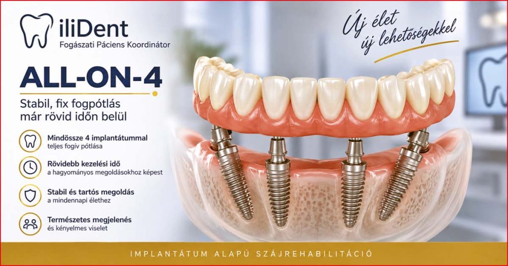 All-on-4 implantátumokkal rögzített teljes fogpótlás