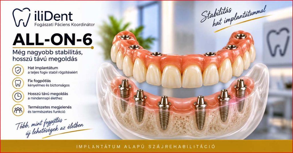 All-on-6 implantátumokkal rögzített teljes fogpótlás